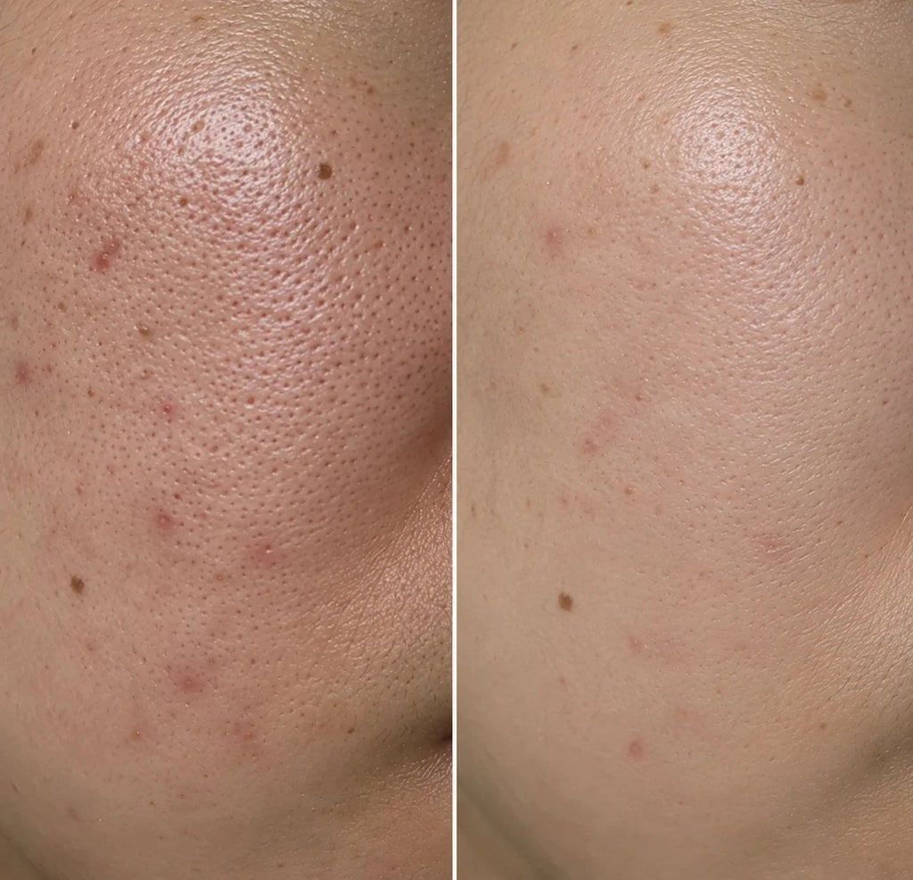 PORE RESET / 모공 리셋